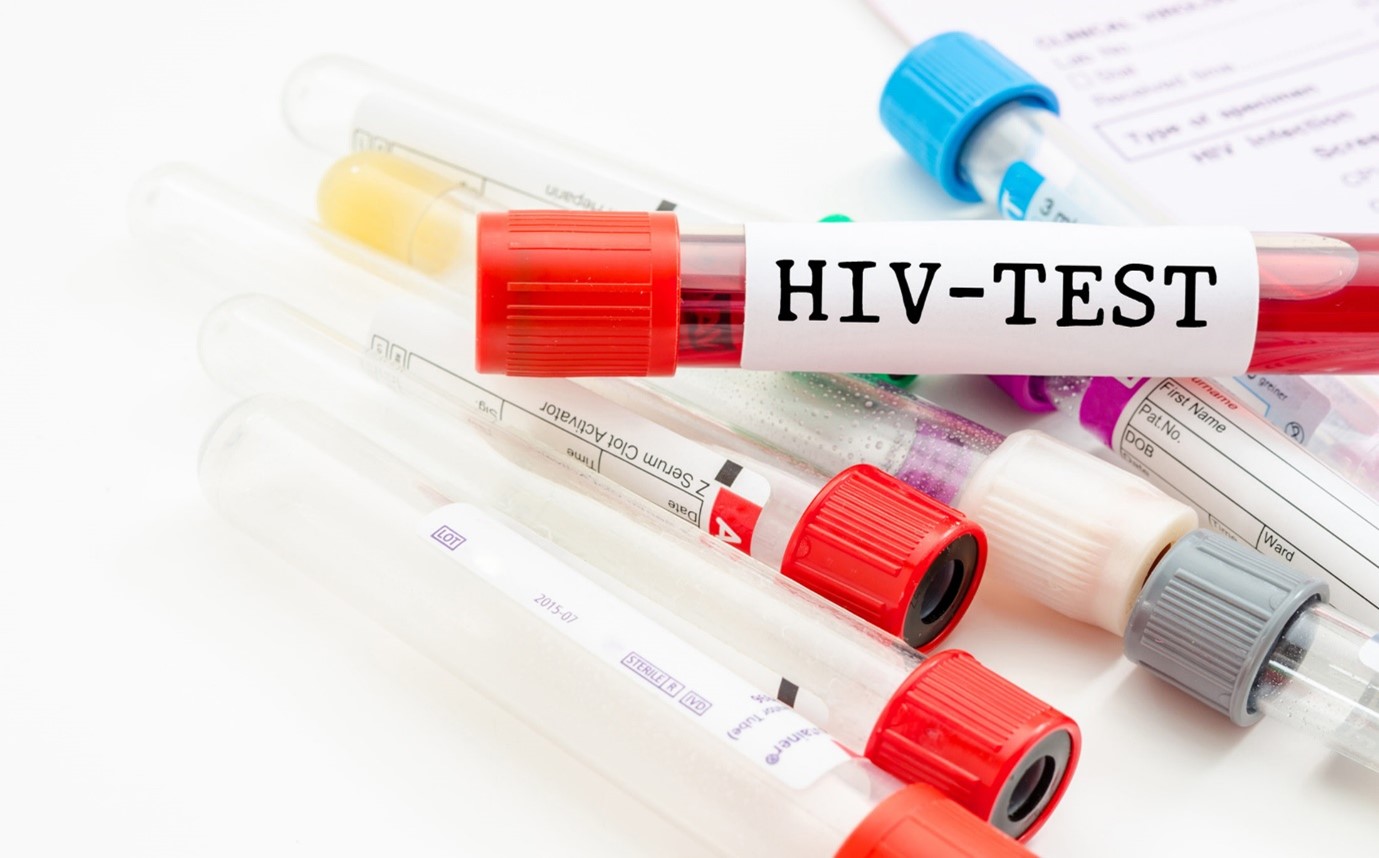 آزمایش ایدز ؛ چگونه ابتلا به ایدز تشخیص داده میشود؟